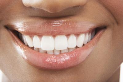 Woman's Smile | Dental Crowns in Randwick NSW